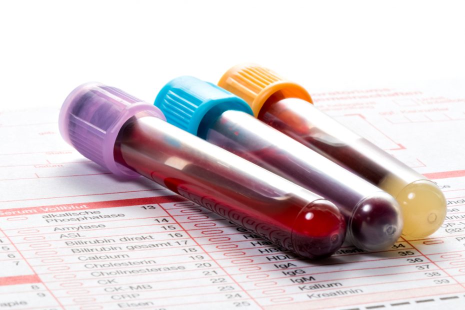 Véres vizeletet okozó betegségek | BENU Gyógyszertárak